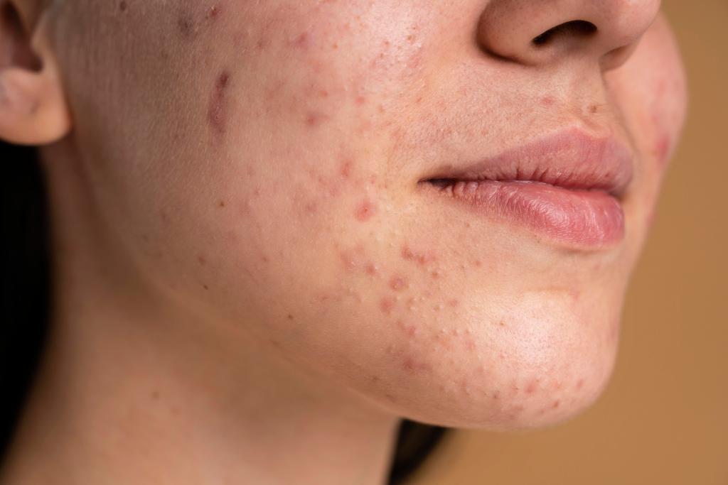 Acne vulgaris (Acne)